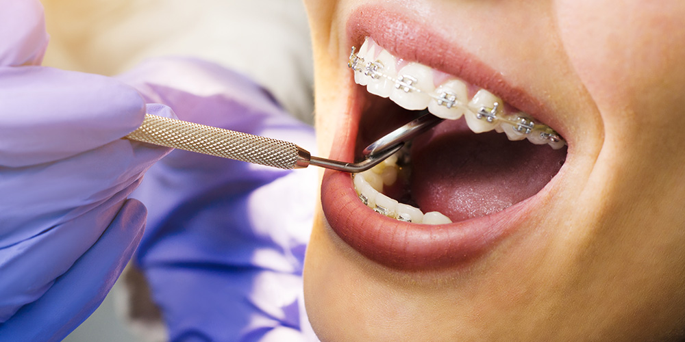 Nazorg orthodontie